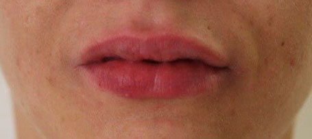 Lippen nach der Unterspritzung