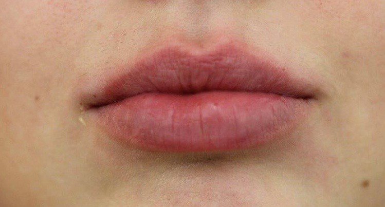 Patientin nach dem Lippen Aufspritzen bei Dr. Doris Wallentin