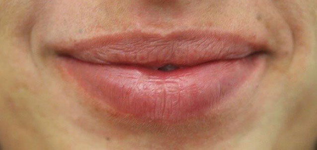 Patientin nach Lippenbehandlung mit Hyaluron Booster Pen