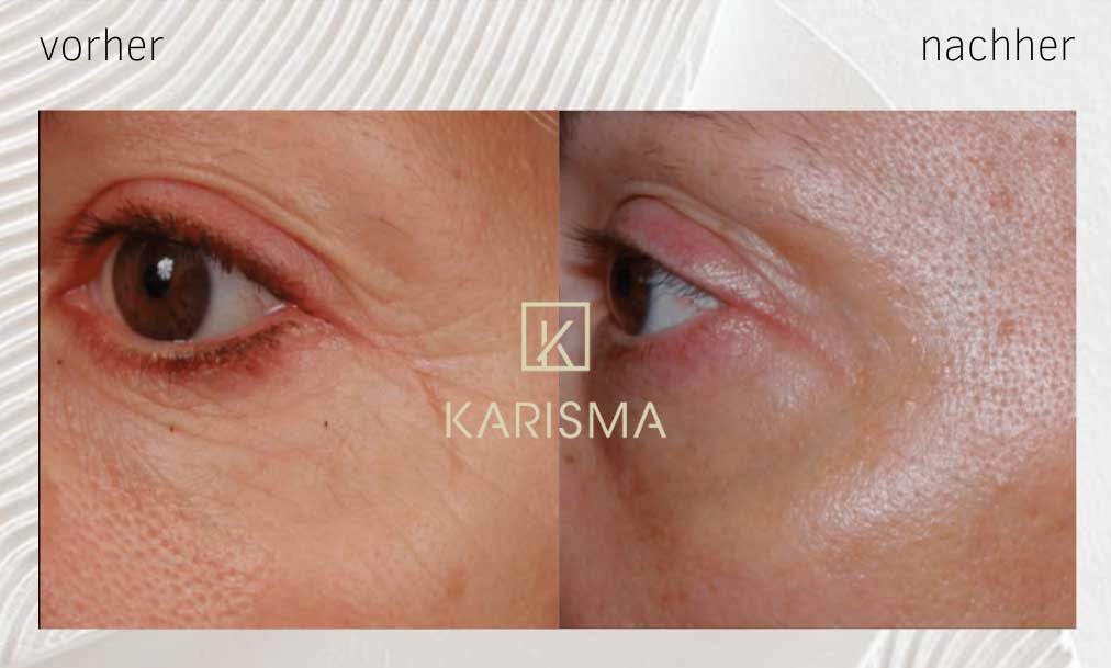 Vorher-Nachher: Augenfalten vor und nach der Behandlung mit Karisma